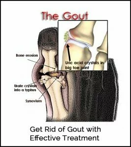 Get Rid of Gout with Effective Treatment