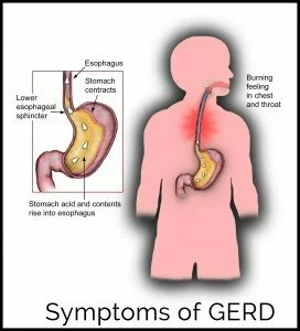 Symptoms of GERD